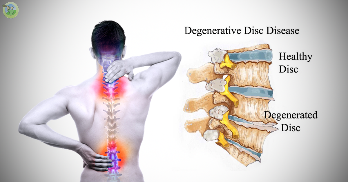 Explore the relationship between degenerative conditions and back pain. Discover how conditions like arthritis and disc degeneration can lead to discomfort, and find insights into managing and improving your quality of life despite these challenges.