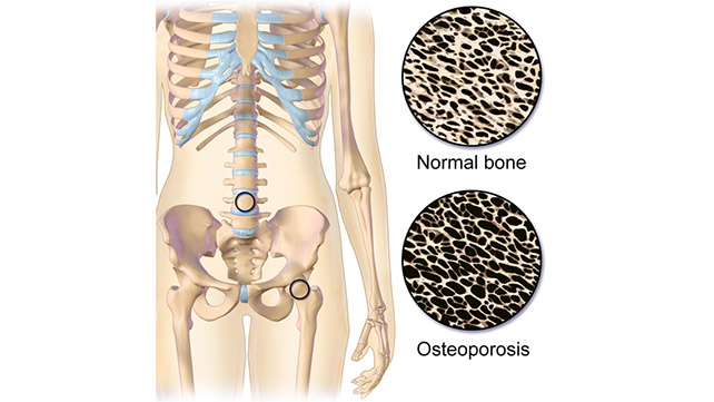 Delve into bone loss causes and risks. Learn about factors contributing to weakened bones and how to protect your skeletal health. Knowledge is the first step to prevention.